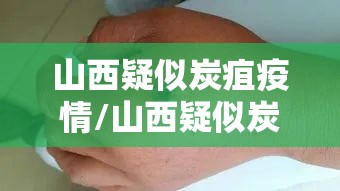 山西疑似炭疽疫情/山西疑似炭疽疫情9人有症状 山西疑似炭疽疫情/山西疑似炭疽疫情9人有症状