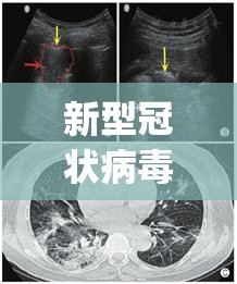 新型冠状病毒死亡病例(新型冠状病毒死亡情况) 新型冠状病毒死亡病例(新型冠状病毒死亡情况)